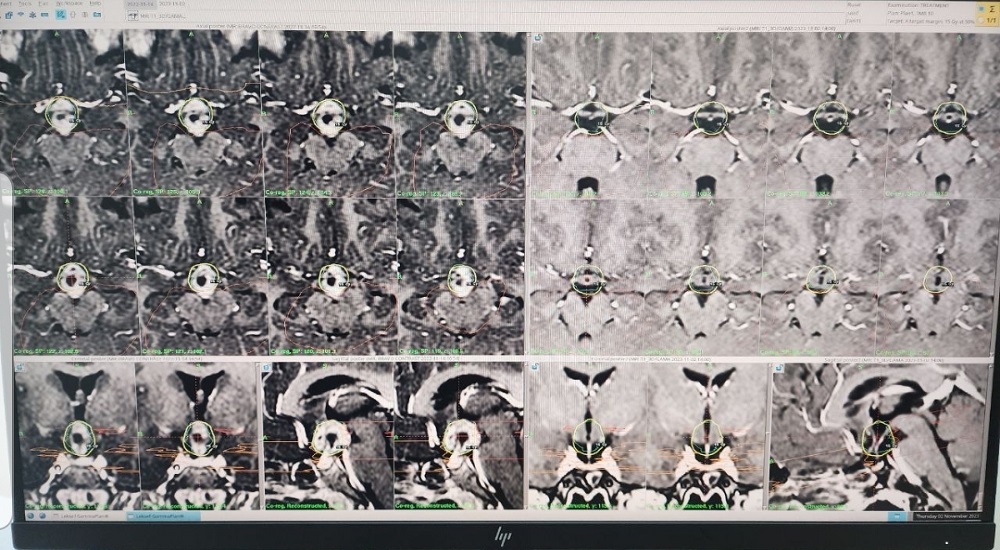   Treatment of brain tumor with gamma rays