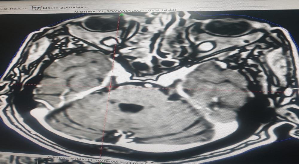 A trigeminal nerve tumor is treated with Gamma Knife radiation.