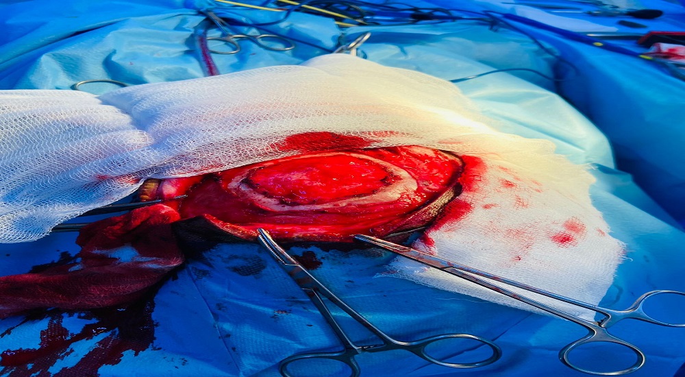 Skull reconstruction surgery with the placement of a mesh.