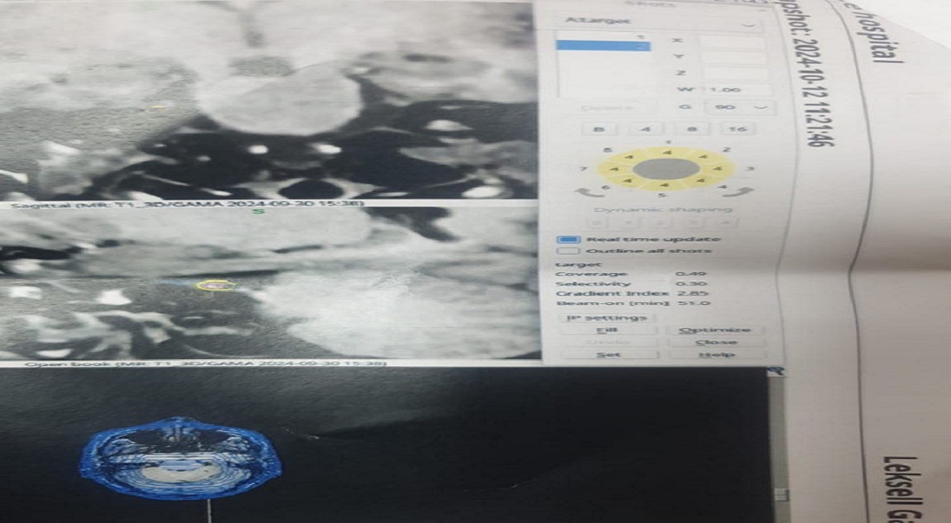 Treatment of trigeminal neuralgia by Professor Dr. Abdul Ameer Jassim Mohammed.